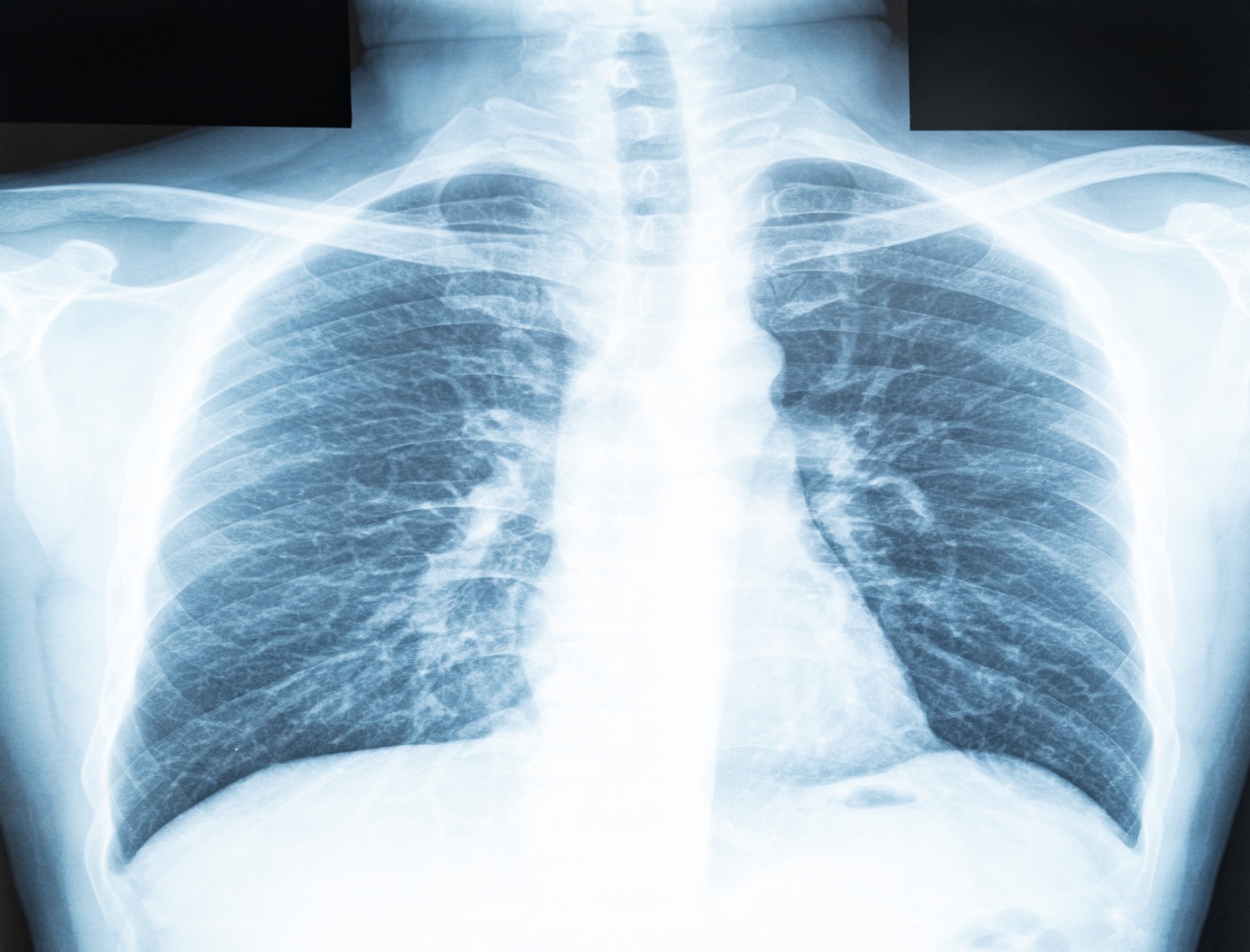 Chest x-ray